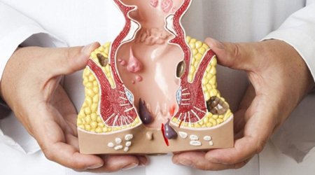 درمان بواسیر یا هموروئید